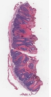 Cutaneous Papilloma